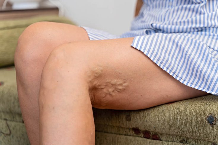 Are Varicose Veins Dangerous?